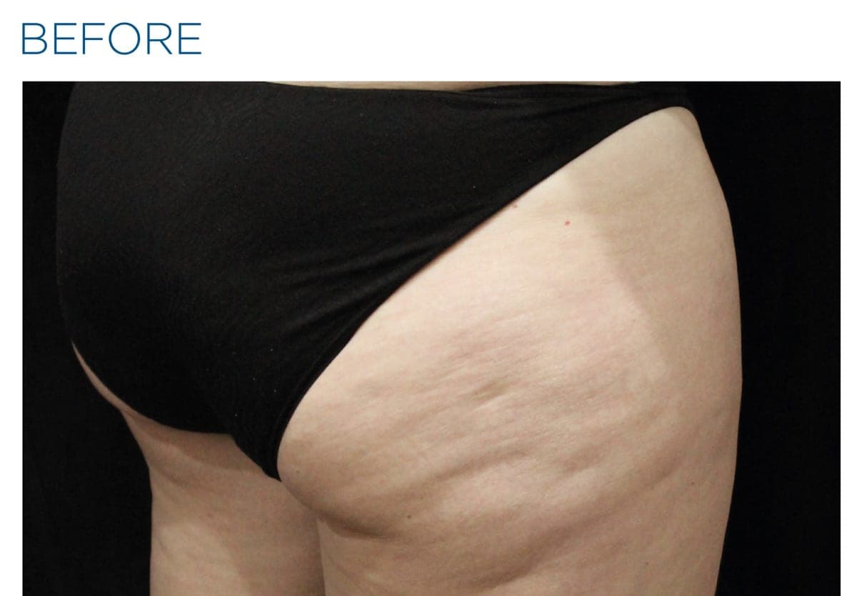 Before-and-after of a female patient's buttock area treated with CELLUTONE combined with Exilis radiofrequency therapy. — before