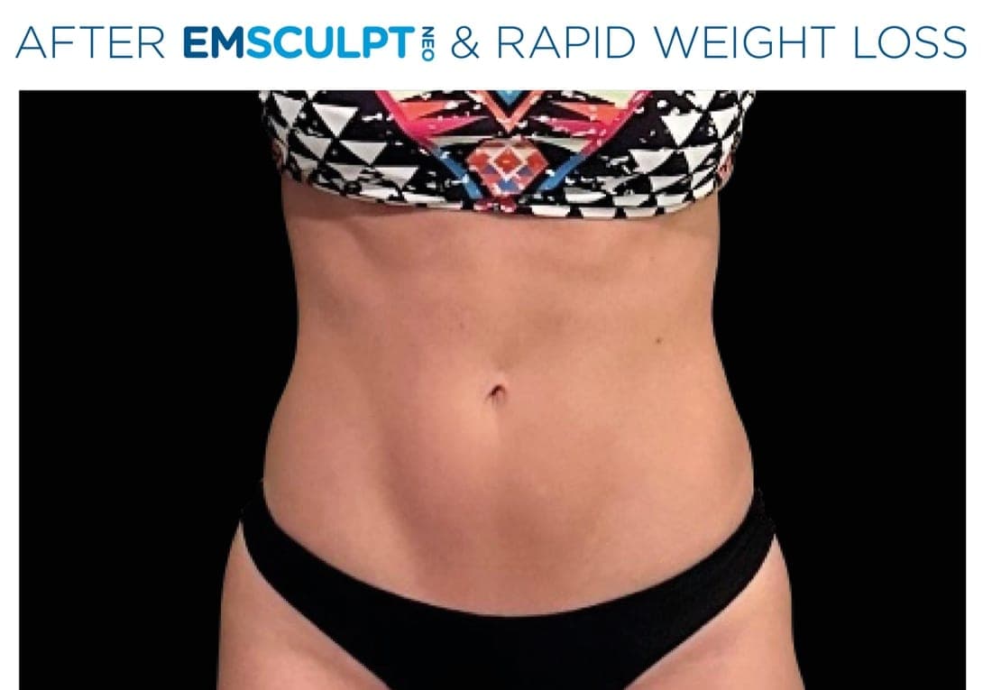 Before and after EMSCULPT NEO treatment of the female abdomen — improved tone and reduced circumference. — after