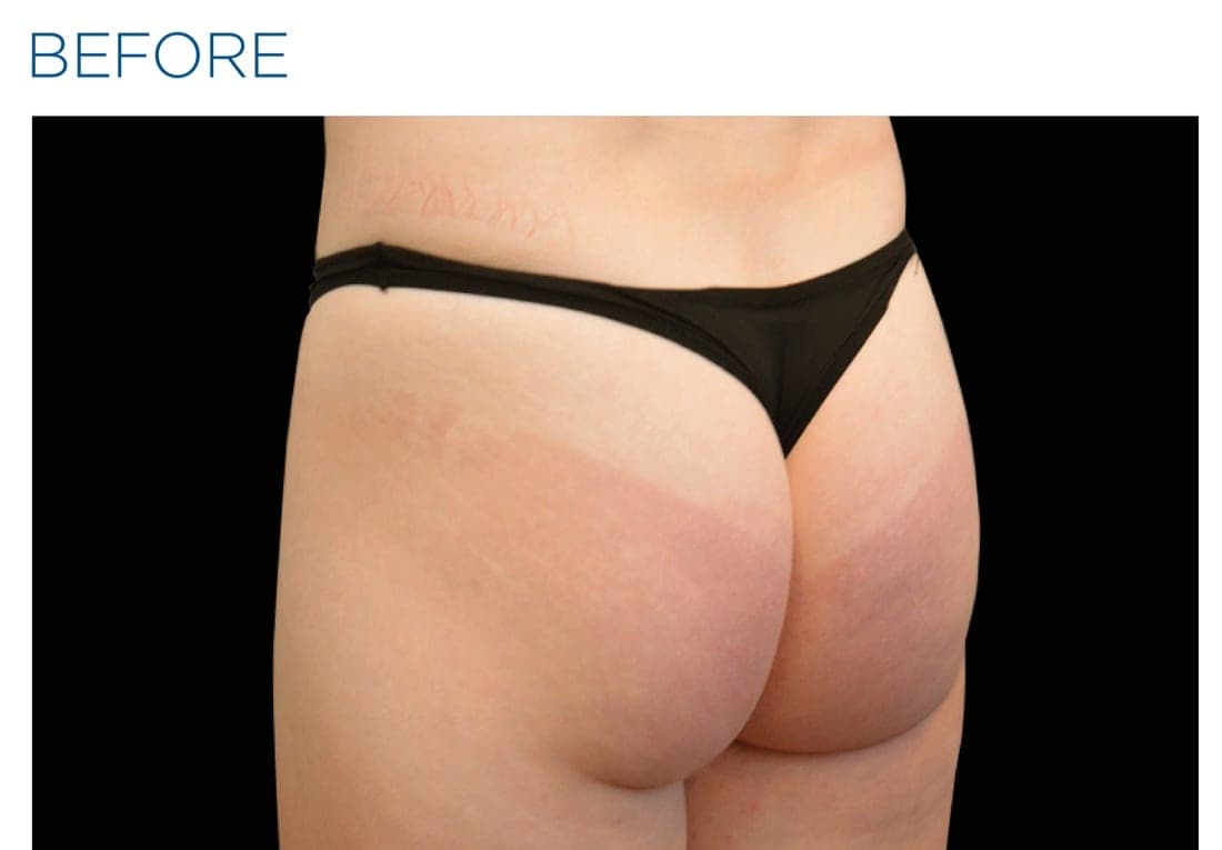 Before and after EMSCULPT NEO treatment of the female buttocks — firming and toning. — before