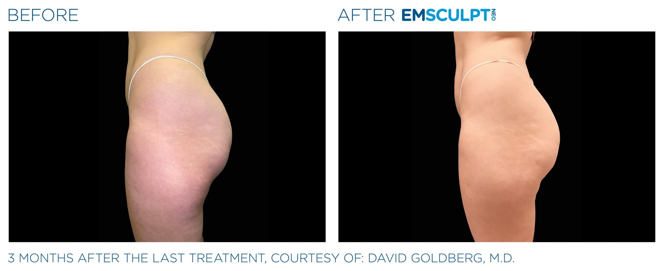 EMSCULPT NEO patient outcome — body sculpting and functional wellness treatment at Neuromag Institute, Tampa FL.