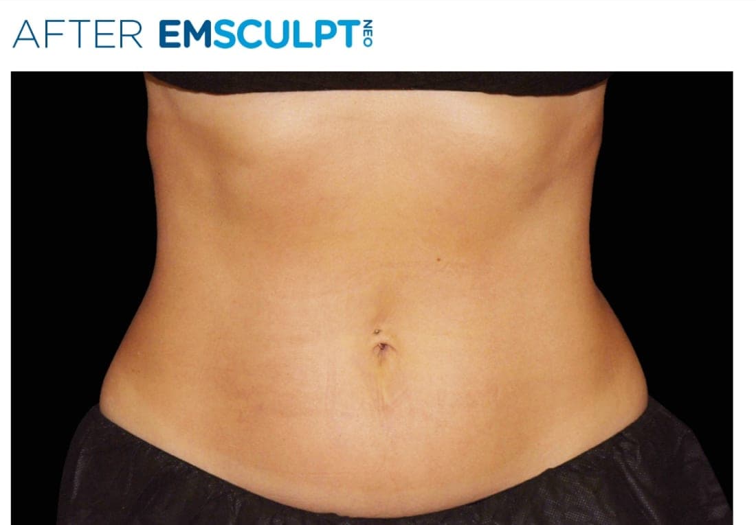 Before and after EMSCULPT NEO treatment of the female lateral abdomen and flanks. — after