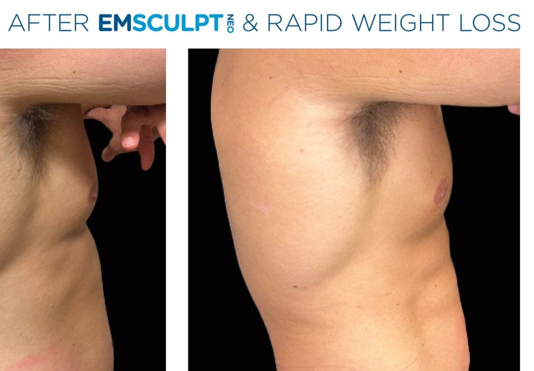 Before and after EMSCULPT NEO treatment of the male abdomen — improved muscle tone and reduced fat. — after