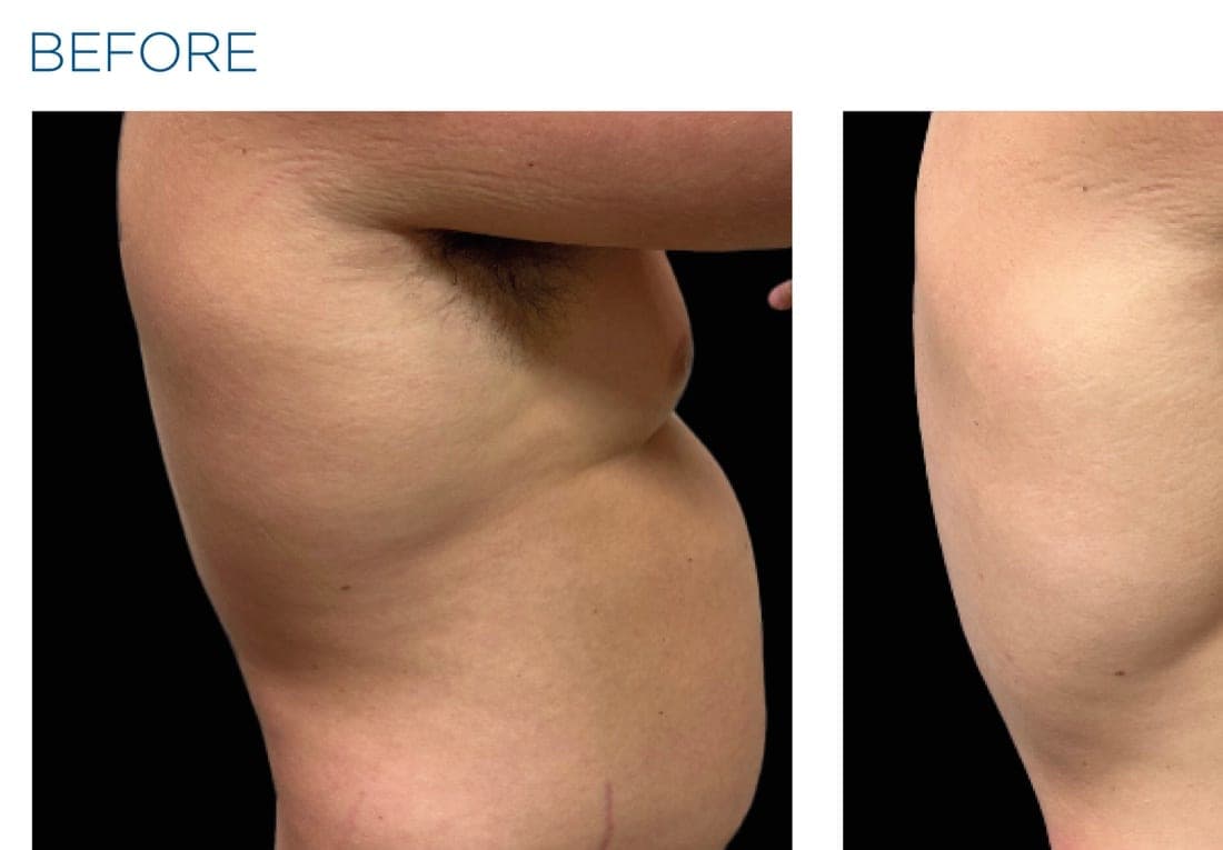Before and after EMSCULPT NEO treatment of the male abdomen — improved muscle tone and reduced fat. — before
